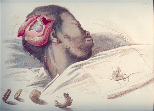 Charles Bell, 'Illustrations of the great operations of surgery,' 1821