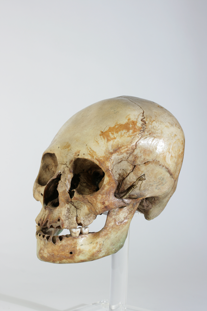 Artificial Cranial Deformation 