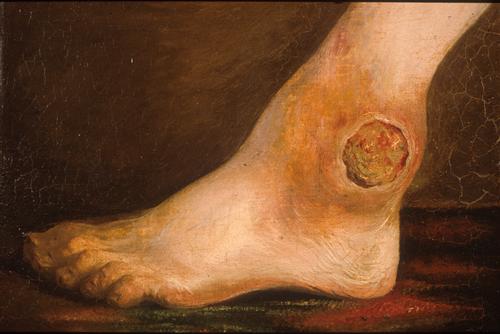 Charles Bell ‘Gunshot wound of the ankle joint,’ oil on canvas