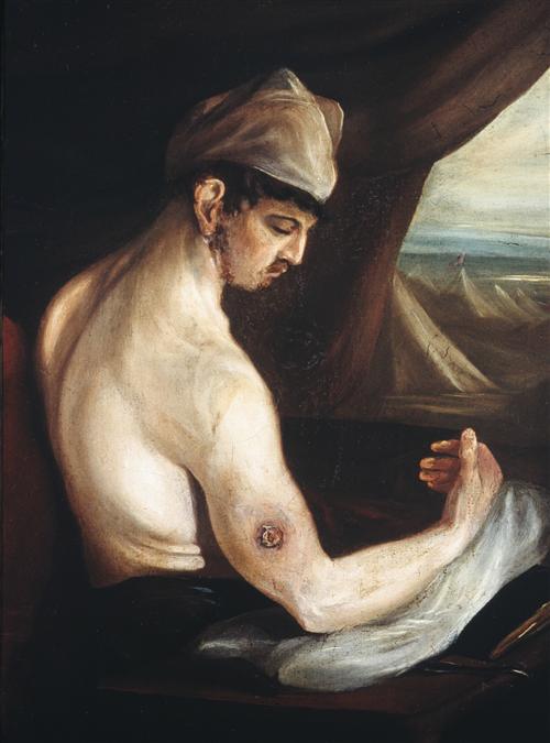 'Gunshot wound of the humerus' by Charles Bell, oil on canvas