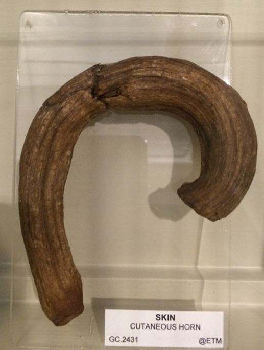 Cutaneous horn
